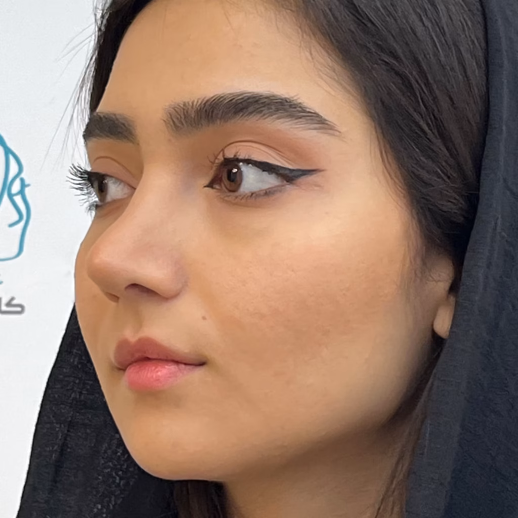 قبل از تزریق فیلر لب