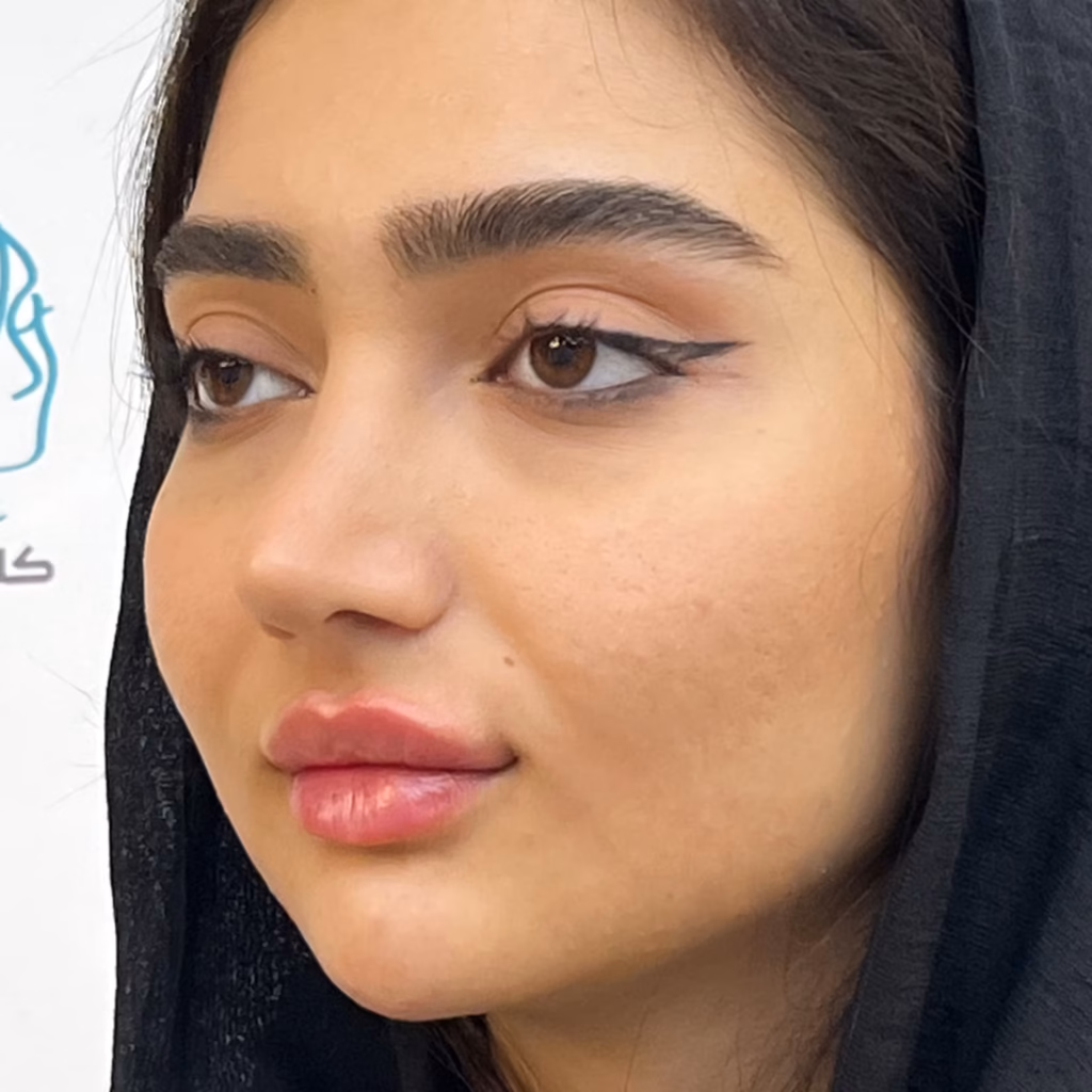 بعد از تزریق فیلر لب