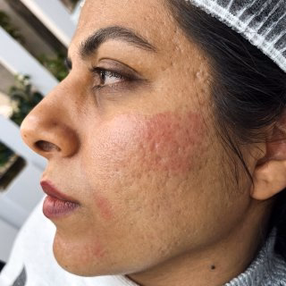قبل از PRP