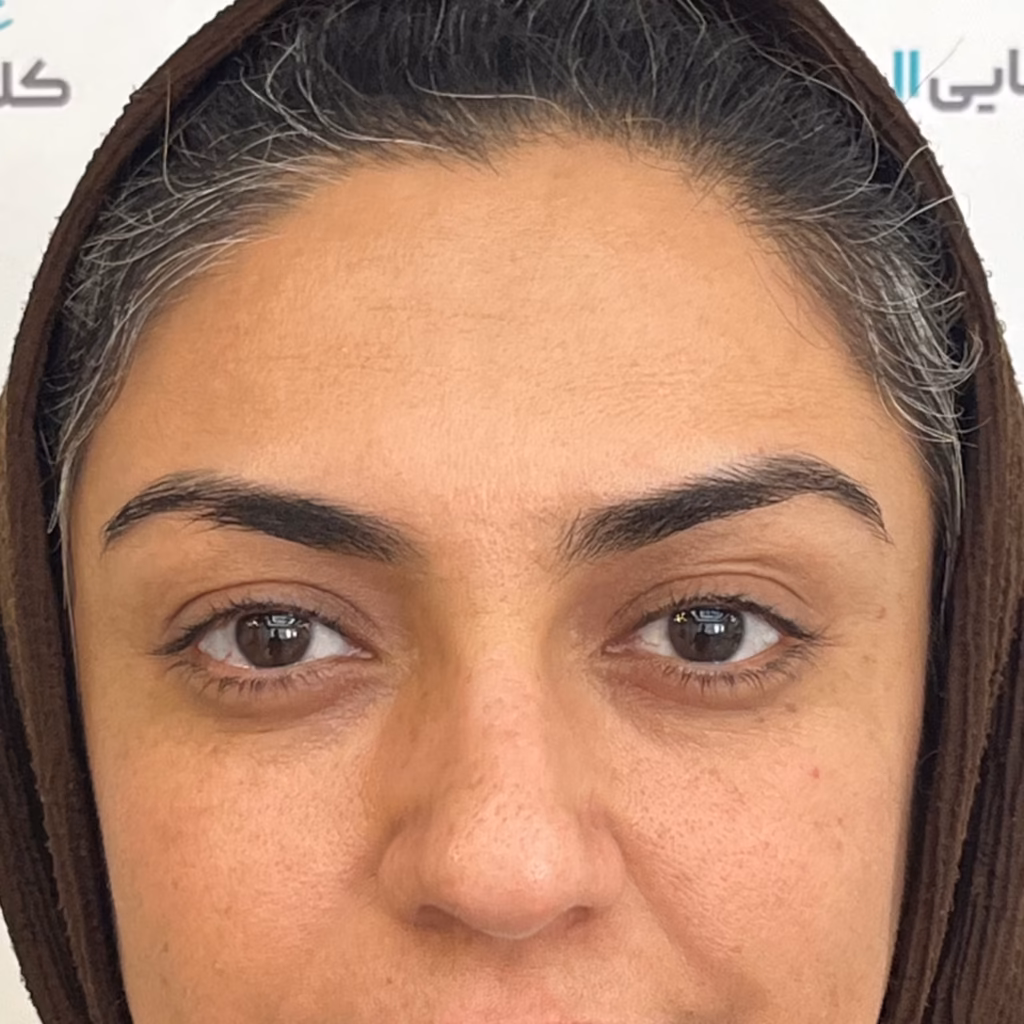 بعد از بوتاکس