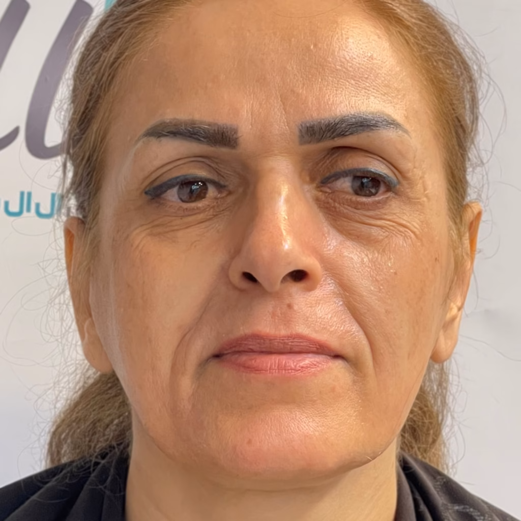 قبل از لیفت با نخ