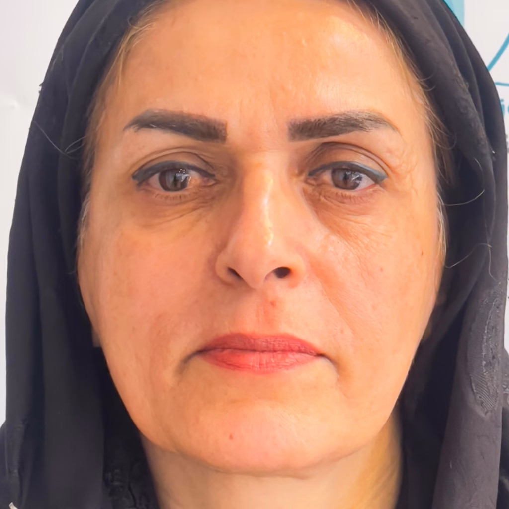 بعد از لیفت با نخ