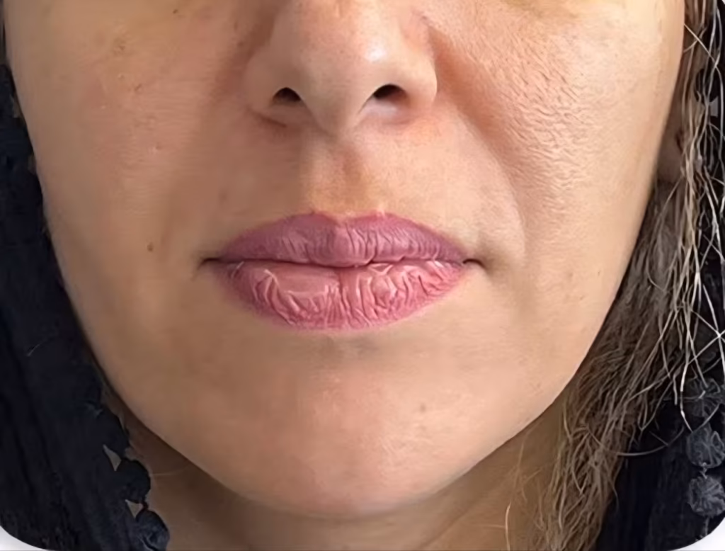 قبل از فیلر خط خنده (خط لبخند)