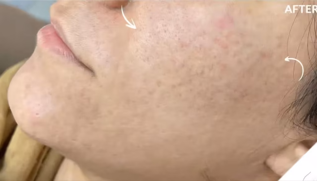 بعد از مزونیدلینگ