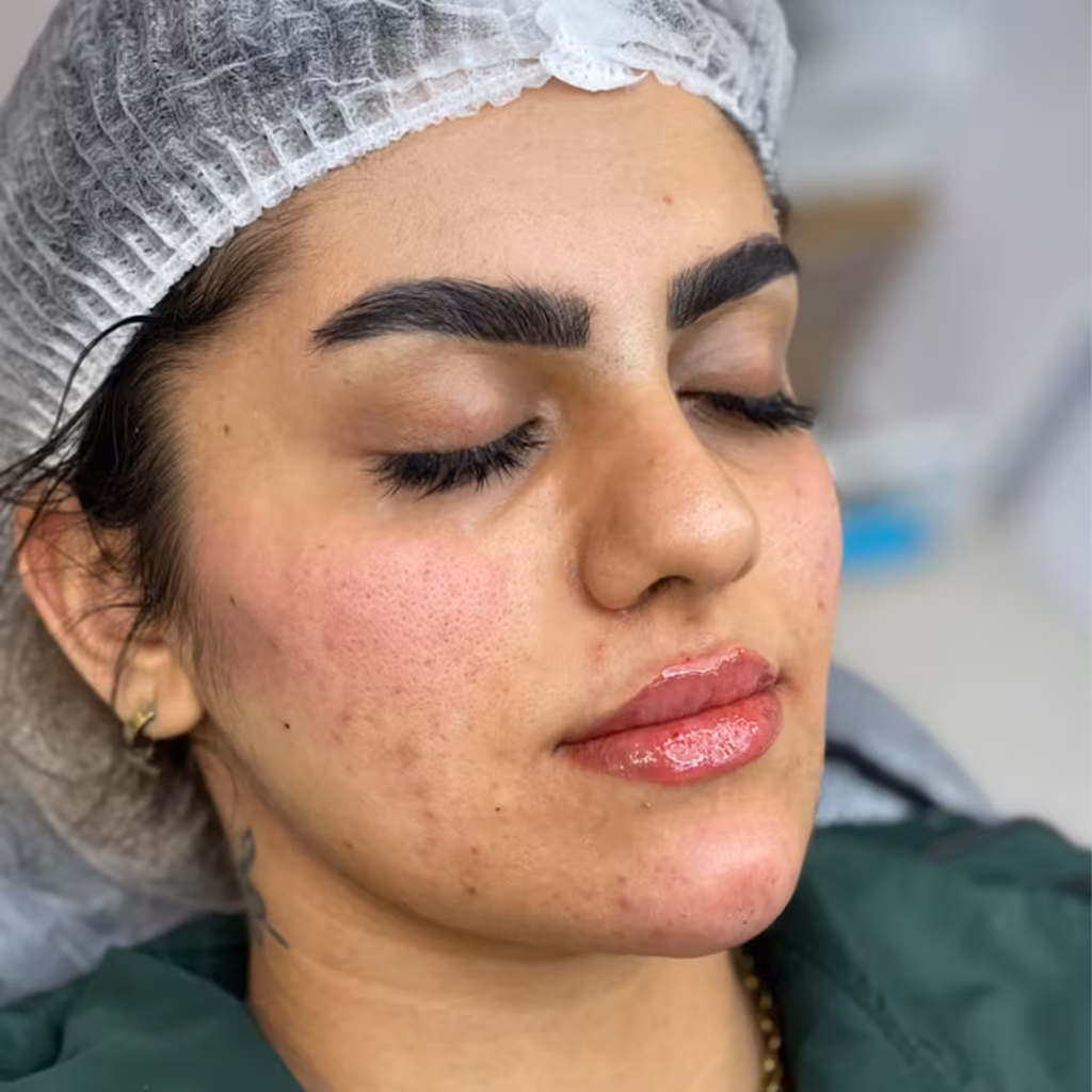 بعد از پکیج کانتورینگ و تناسب چهره (فیلر گونه، چانه و لب)