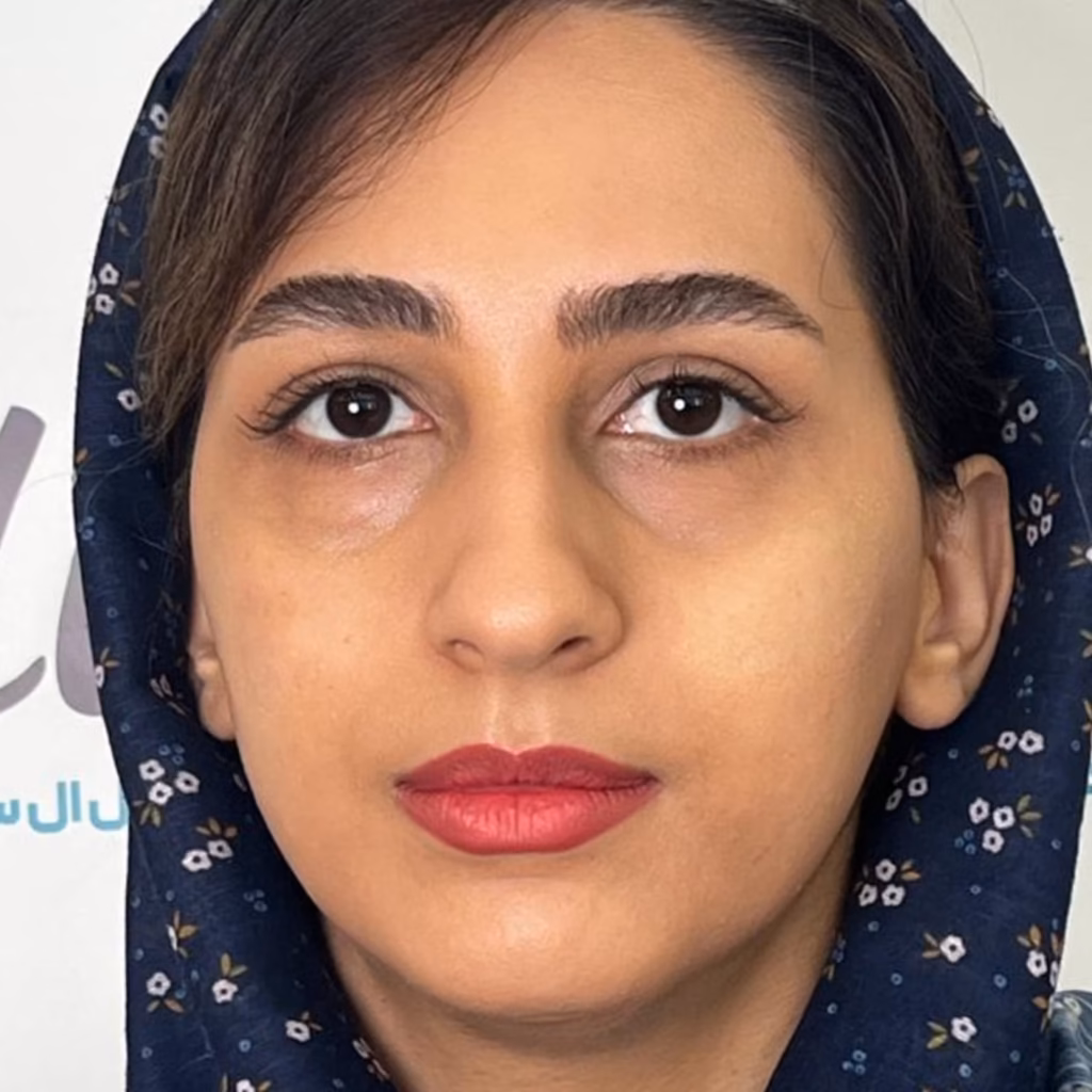 قبل از  فیلر زیر چشم
