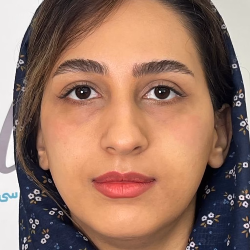 بعد از  فیلر زیر چشم