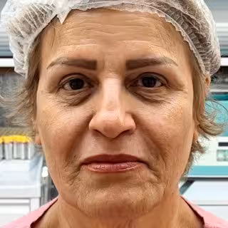 قبل از مزوژل