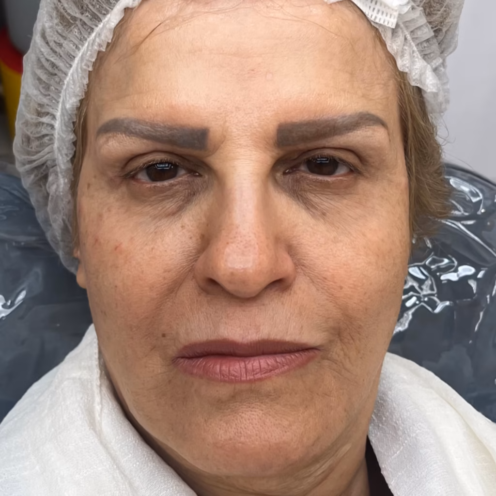 بعد از مزوژل
