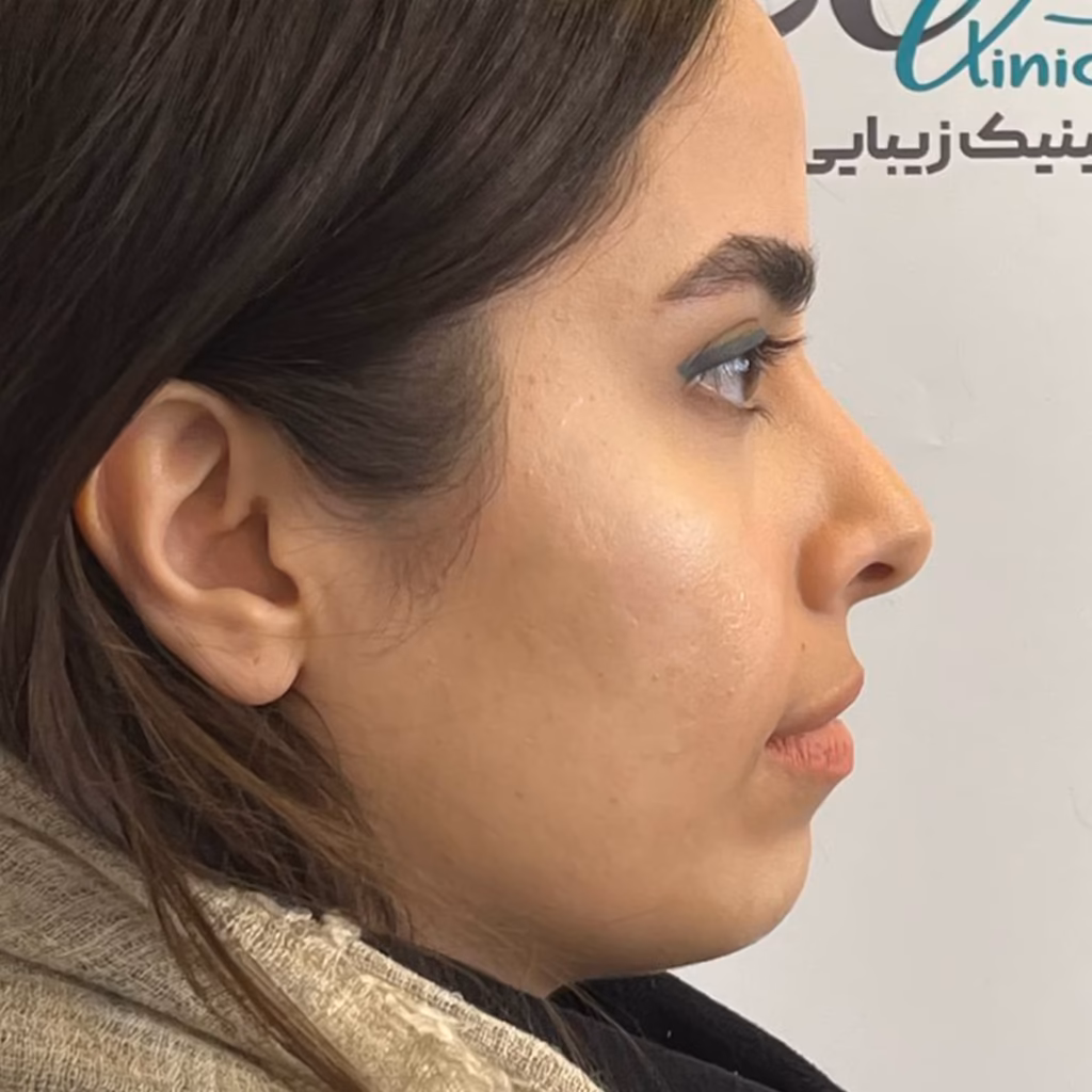 قبل از فیلر چانه